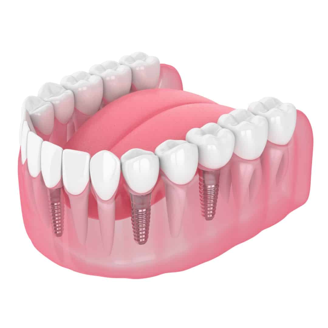 Multiple-Dental-Implant