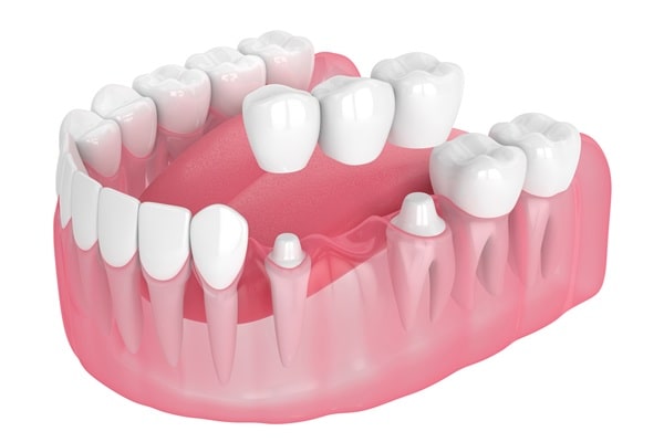 dental-bridges
