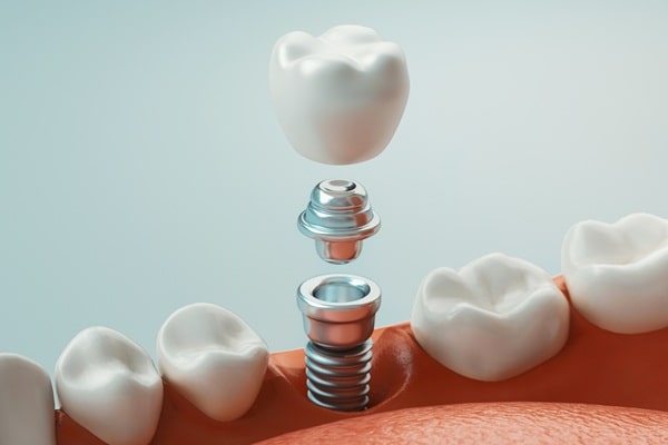 dental-implants
